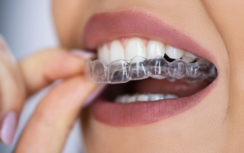 When an Invisalign Dentist Says No: Honest Guidance for Better Outcomes